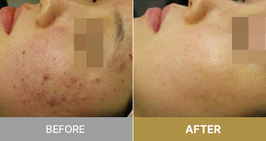 Acne care / にきびケア