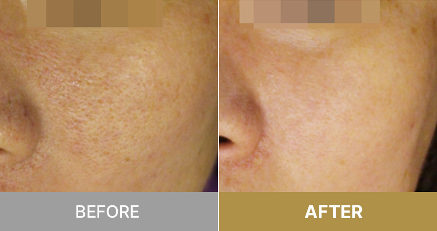 Freckle and pigment care / シミ、色素ケア