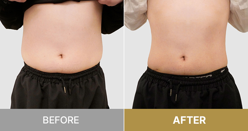 Abdominal CAT / 腹部キャット