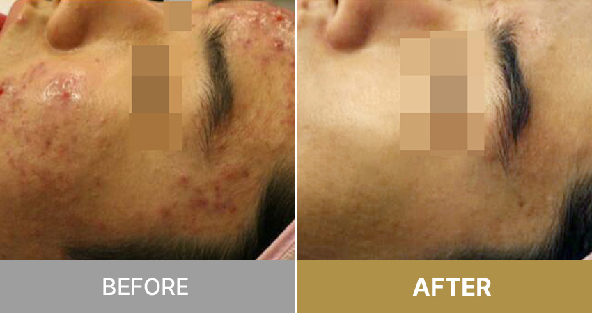Acne care / にきびケア